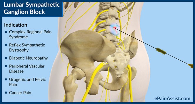 lumbar-sympathetic-ganglion-block-b